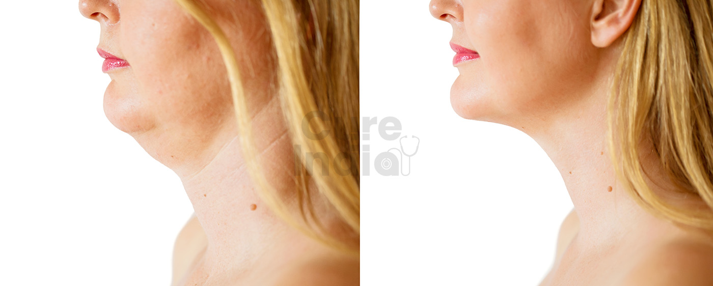 Chin Lift